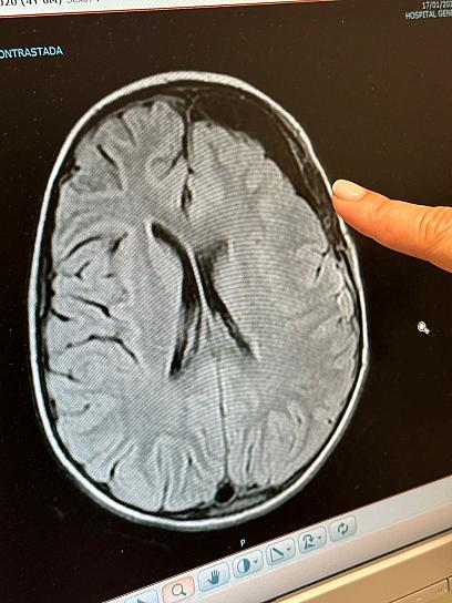 Concientiza Secretaría de Salud sobre Epilepsia