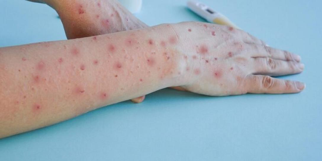 CONFIRMA AGUASCALIENTES SU PRIMER CASO DE LA VIRUELA DEL MONO