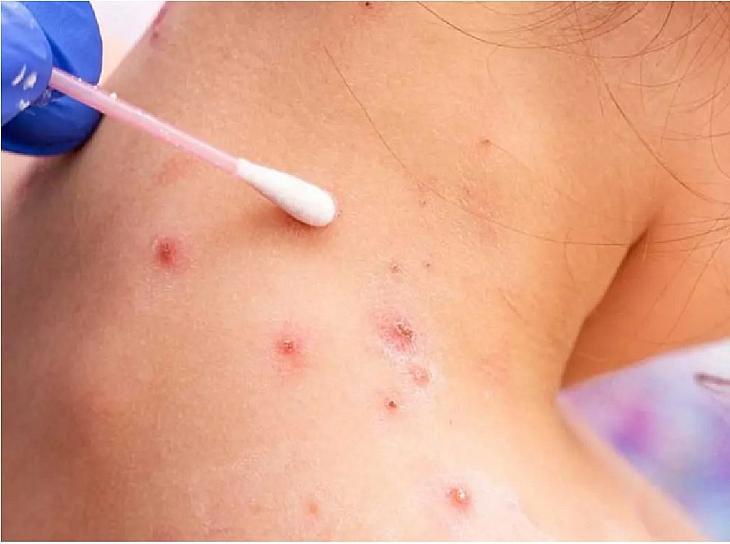  CONFIRMA LÓPEZ GATELL PRIMER CASO DE VIRUELA DEL MONO EN MÉXICO 