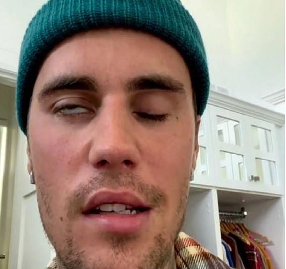  JUSTIN BIEBER CANCELA SU GIRA POR VIRUS QUE LE PROVOCÓ PARÁLISIS FACIAL