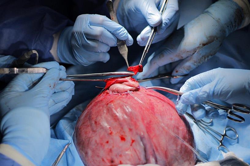 REALIZA ISSSTE PRIMERA CIRUGÍA FETAL DE SU HISTORIA EN EL CMN “20 DE NOVIEMBRE” 