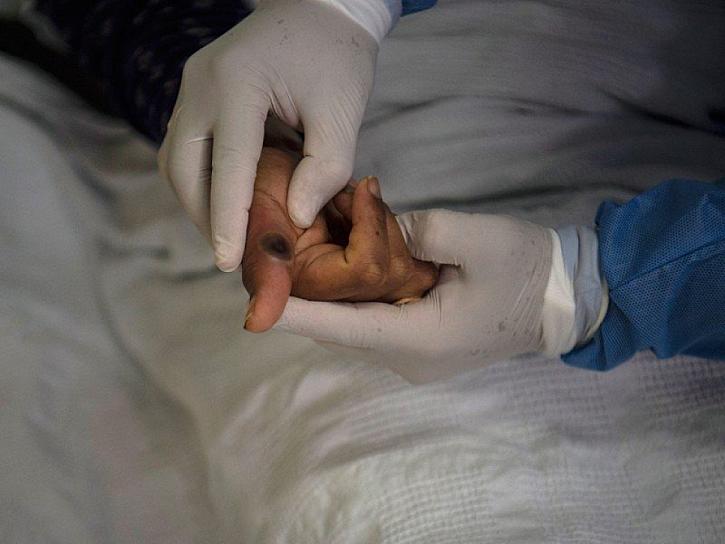 REPORTA CUBA MUERTE DE TURISTA INFECTADO CON VIRUELA DEL MONO