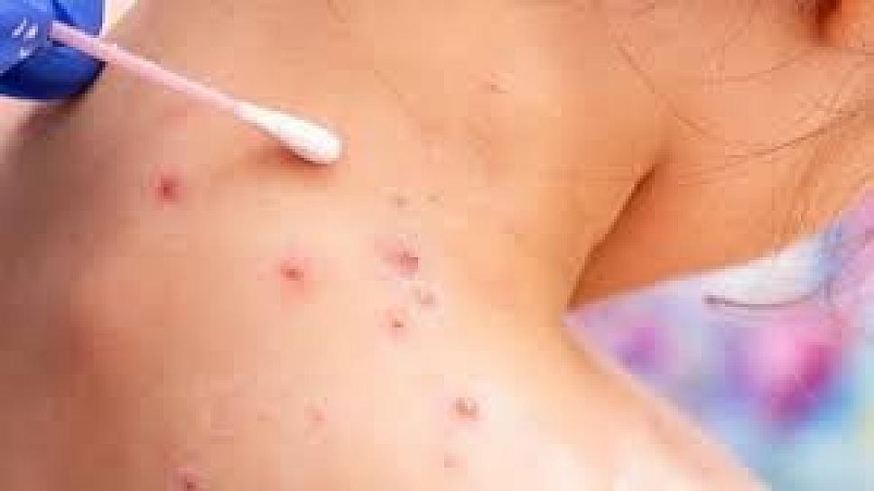 REPORTA MÉXICO 91 CASOS DE VIRUELA DEL MONO; NO HAY FALLECIMIENTOS 