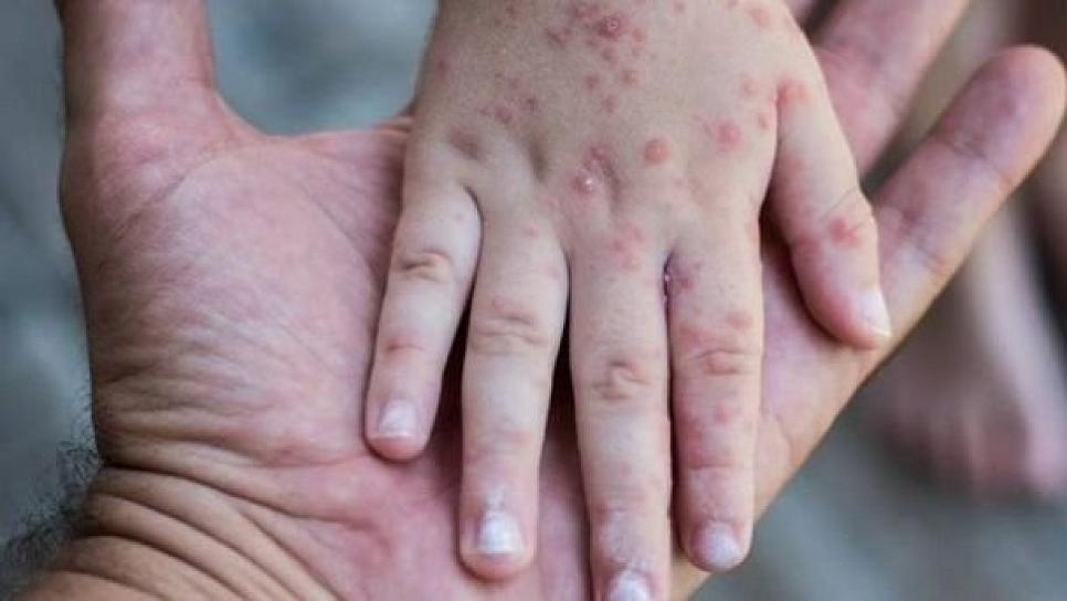 Suman 17 casos por brote de sarampión en comunidad menonita de Chihuahua