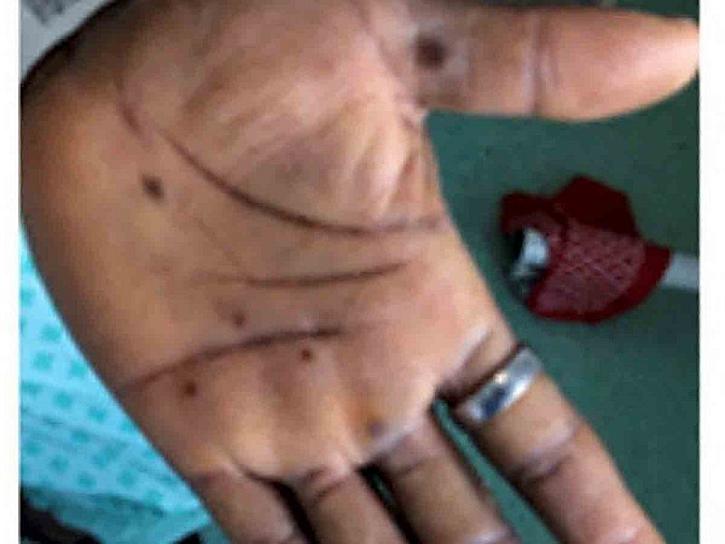 UN HOMBRE DE 27 AÑOS, PRIMER CASO DE VIRUELA DEL MONO EN OAXACA