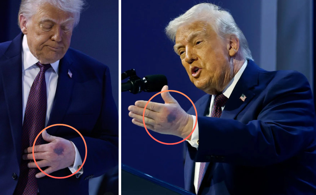 REAVIVA TRUMP DEBATE SOBRE SU SALUD POR MORETONES VISIBLES EN MANOS